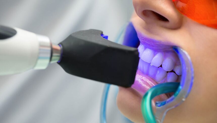 Teeth Whitening