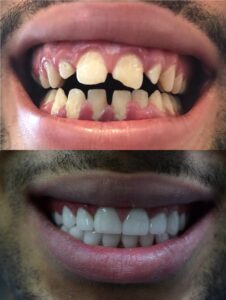Before After Zirconium 11