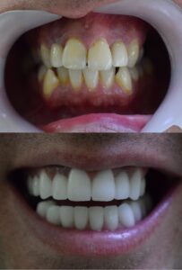 Before After Zirconium 19