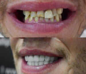 Before After Zirconium 31