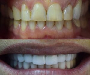 Before After Zirconium 32