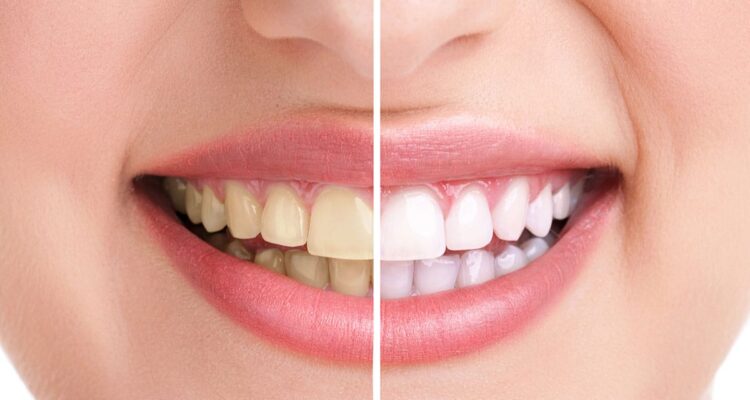 Teeth Plaque