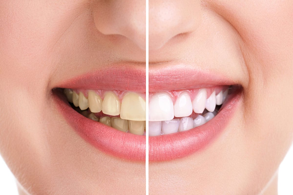 Teeth Plaque