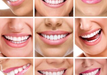 All About Dental Veneers