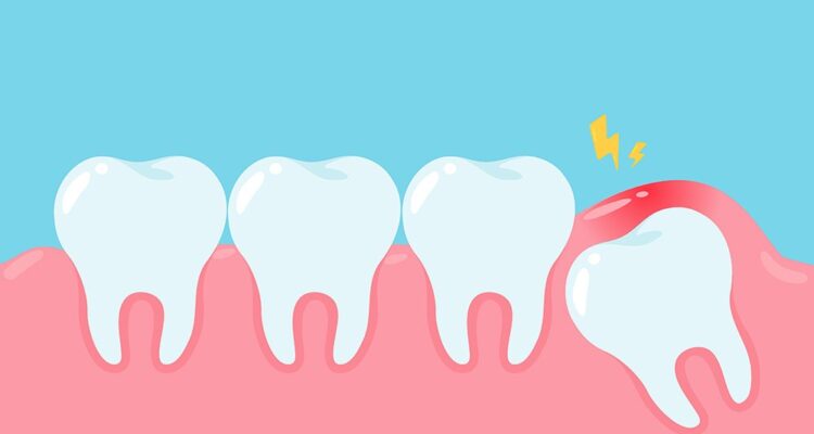 All About Wisdom Teeth