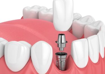 dental-implants-in-turkey