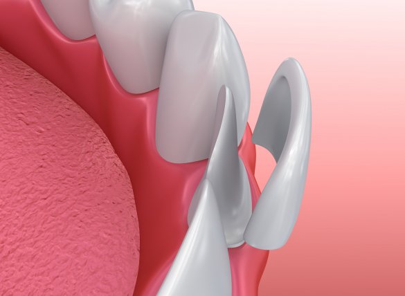 dental-veneers-in-turkey