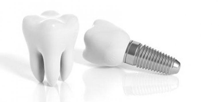 full mouth implants price in turkey