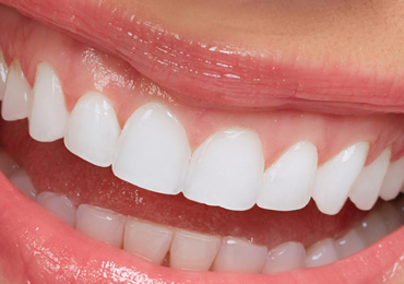 full set of veneers price in turkey