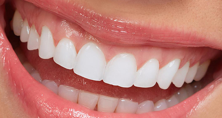 full set of veneers price in turkey