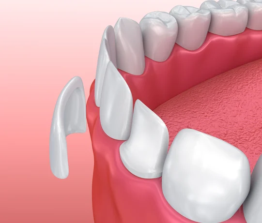 Dental Veneers in Turkey